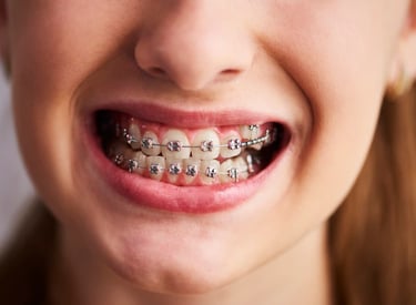aparelho dentário 