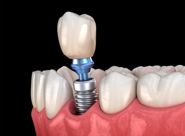 ilustração implante dentário