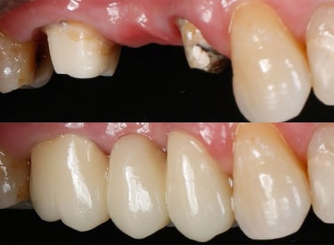 foto prótese fixa sobre dentes