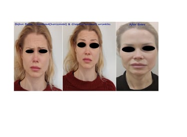 Botox before and after. Botox for upper face to reduce wrinkles on forehead & between eyebrows.
