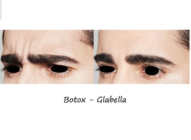 Före- & efterbild botox glabella – slätare bekymmersrynkor och avslappnat, harmoniskt utseende.