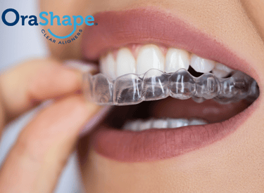 Orashape Clear  Aligner