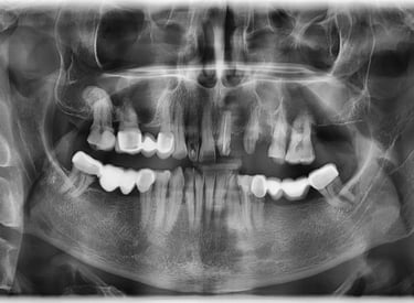 Rezectie apicala + chistectomie