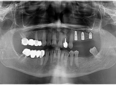 Sinus Lifting + Implantologie