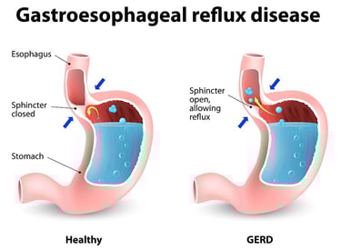 GASTRO FOUNDATION gastroesophageal reflux diseaese ,adult