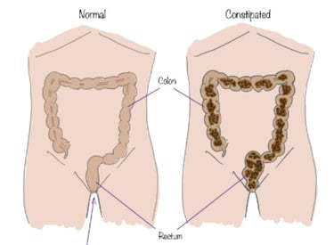 Constipation -ADULT GASTRO FOUNDATION