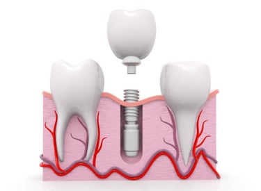 explaining dental implanting procedure diagram