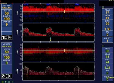 Transcranial Doppler TCD microembolus MES
