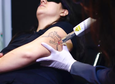 remoção de tatuagem no braço com laser