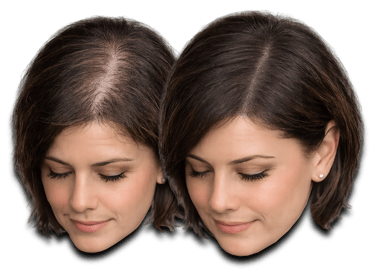 a before/after photo of a woman who has received an SMP treatment on her scalp