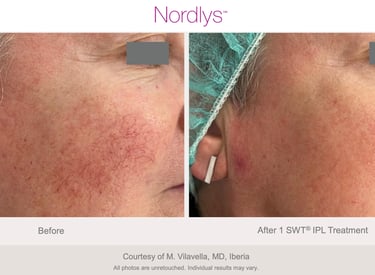 improved skin tone and radiance after professional skin rejuvenation in Hamilton clinic