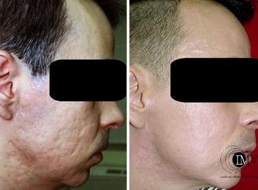 Tratamiento Acné, Laser Piel, Cambrils, Tarragona, Instituto Médico Vilafortuny,