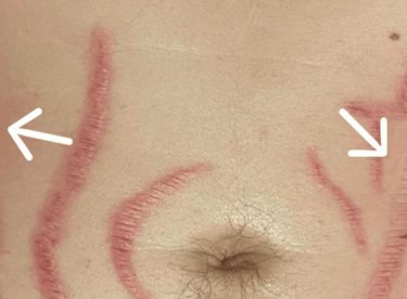 inflamed belly scars