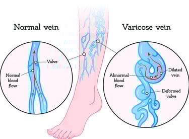 ablation vascular ultrasound varicose vein sclerotherapy radiofrequency laser leg pain swelling ulcer insufficiency chronic