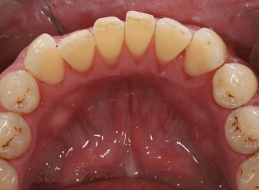 After dental cleaning showing fully cleaned lower teeth at Shree Dental Care Shyamal Ahmedabad