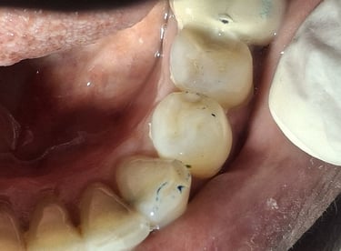 after root canal treatment and proper filling at shree dental care near shyamal