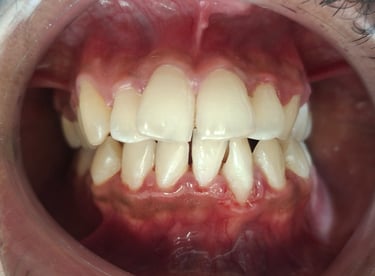 After dental cleaning showing polished lower incisors at Shree Dental Care Shyamal Ahmedabad