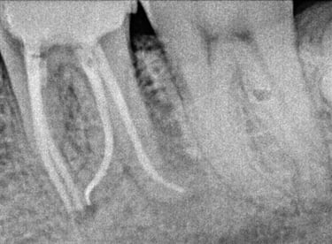 Healthy restored molar after root canal treatment at shree dental care