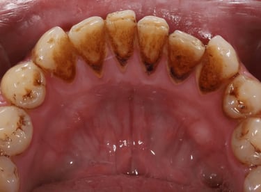 Before dental cleaning showing heavy calculus seen inside of lower teeth in Shyamal Ahmedabad