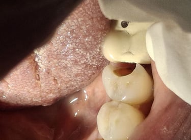 before root canal treatment carious tooth showing pain and food lodgement at shree dental care