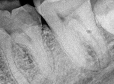 Deep cavity in molar tooth before root canal treatment at shree dental care