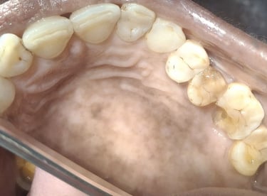 broken upper back molar tooth requiring rct before crown at shree dental care