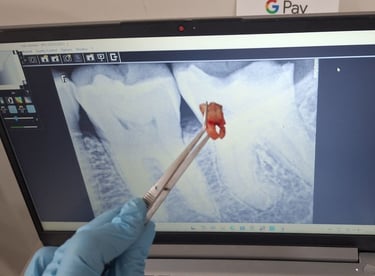 picture of removed third molar with its xray at shree dental care near shyamal ahmedabad