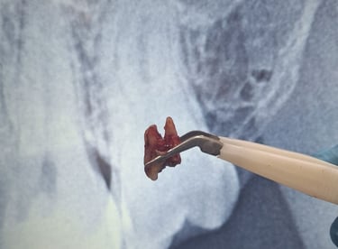 Carious third molar tooth removed during dental extraction procedure in Ahmedabad shree dental care