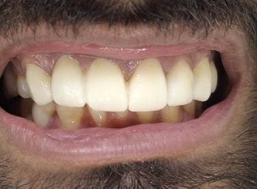 Full mouth rehabilitation after treatment showing healthier smile and function at shree dental care
