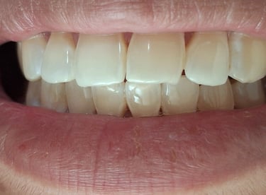 After whitening showing refreshed and brighter smile at Shree Dental Care Shyamal Ahmedabad