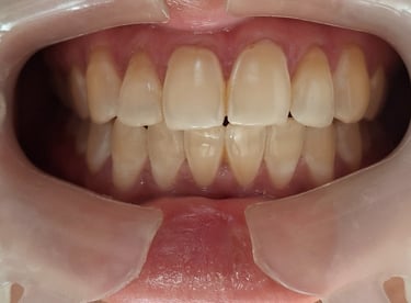 Before whitening showing dull enamel appearance with generalized yellowing in Shyamal Ahmedabad