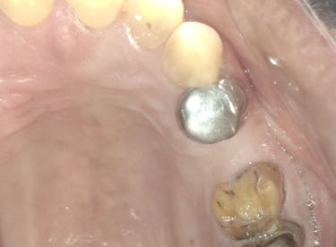 loss of old crown and hypersensitivity of upper back tooth at shree dental care