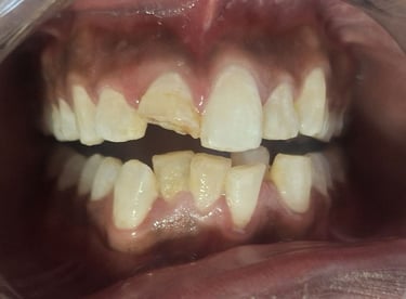 broken front tooth before tooth colored fillings at shree dental care near satellite