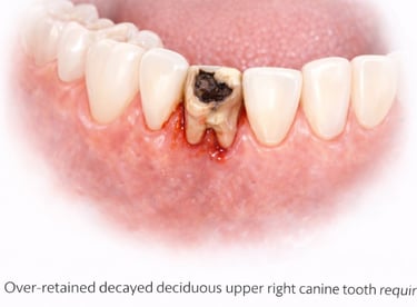 illustration showing milk tooth between permanent teeth at shree dental care near shyamal
