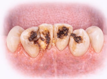 crowded teeth unable to keep clean and carious state requiring cleaning and/or extraction