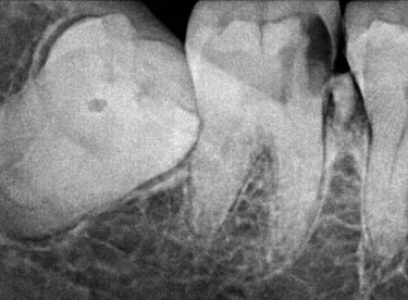 real xray of patient with impacted third molar at shree dental care near shyamal ahmedabad