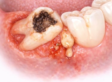 carious and tilted third molar causing pain and pressure on second molar