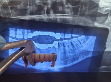 infected old bridge removed under proper aseptic technique at shree dental care