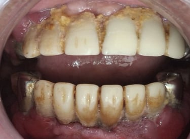 infected old bridge with bleeding gums and pain at shree dental care ahmedabad