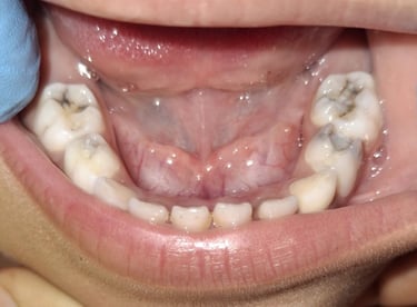 kids teeth carious both sides requiring rct presented at shree dental care