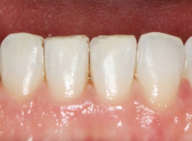 After dental cleaning showing polished lower teeth at Shree Dental Care Shyamal Ahmedabad