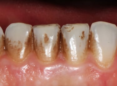  Before dental cleaning showing heavy stains buildup on lowerteeth in Shyamal Ahmedabad