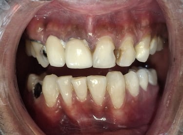 Full mouth rehabilitation case before treatment showing weak teeth and gums at shree dental care