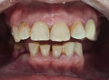 Multiple teeth damage before full mouth rehabilitation dental treatment in Shree dental Ahmedabad