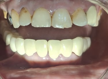 Multiple teeth restored after full mouth rehabilitation improving chewing efficiency at shree dental