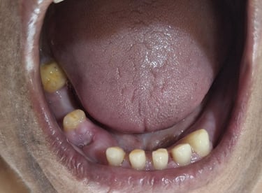 Loss of oral function and uneven teeth before full mouth rehabilitation at Shree Dental Care