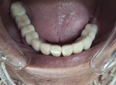Restored oral function and improved bite after full mouth rehabilitation in shree dental care
