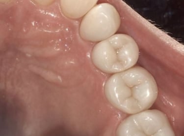 after rct and crown placement at shree dental care near shyamal ahmedabad