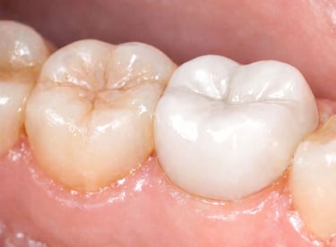 Pain-free tooth after root canal treatment and crown near shyamal at shree dental care