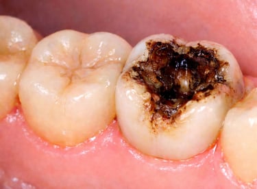 Deep cavity in molar tooth before root canal treatment at shree dental care near shyamal